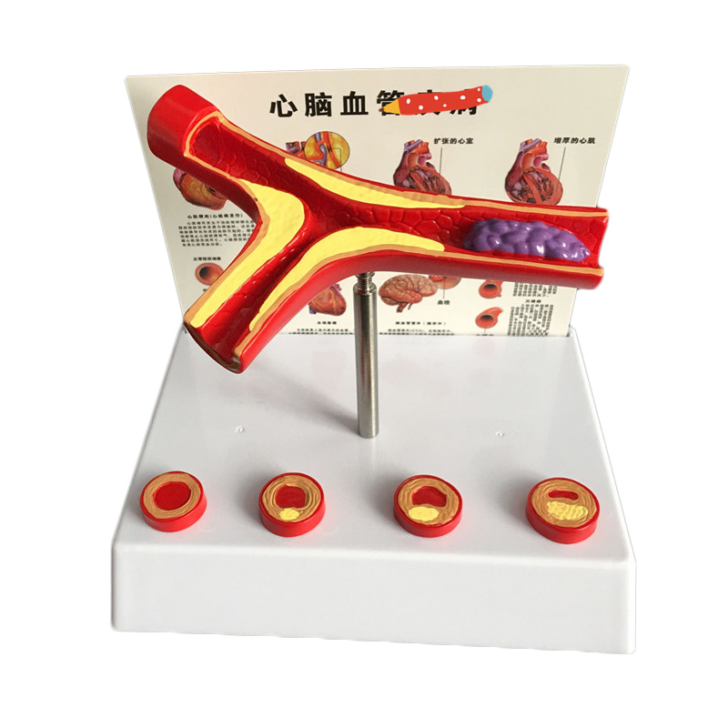 Medical Lab Supplies - 50 Times Enlarged Human Vessel Atherosclerosis