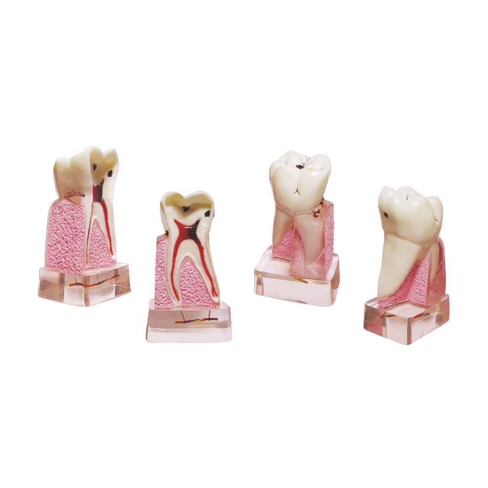 Dental Pathological Model, 4x  - Medical Lab Supplies 评论和价格